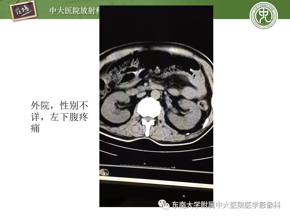 【PPT】肠道急腹症的影像诊断