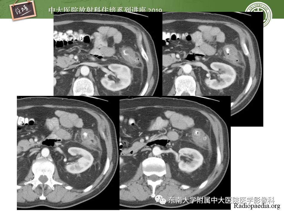 【PPT】肠道急腹症的影像诊断