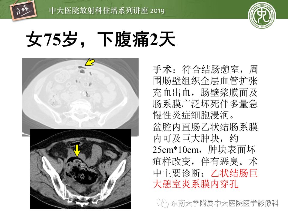 【PPT】肠道急腹症的影像诊断
