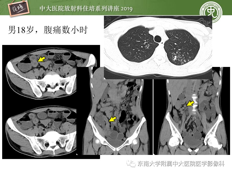【PPT】肠道急腹症的影像诊断