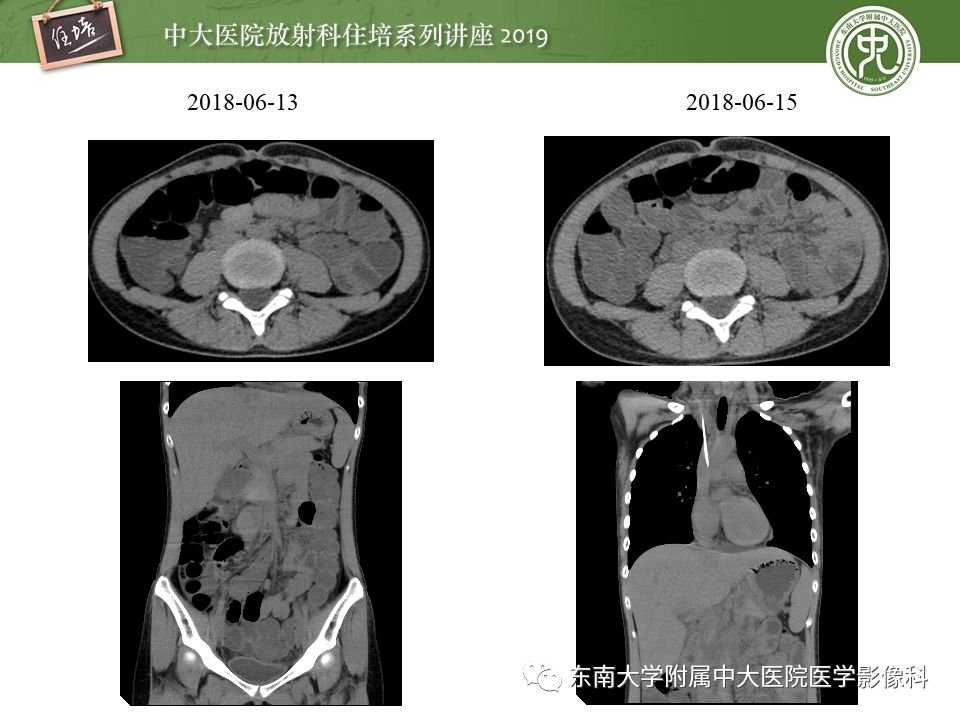 【PPT】肠道急腹症的影像诊断