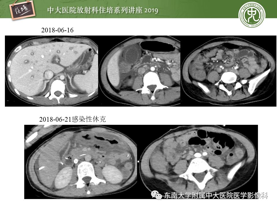 【PPT】肠道急腹症的影像诊断