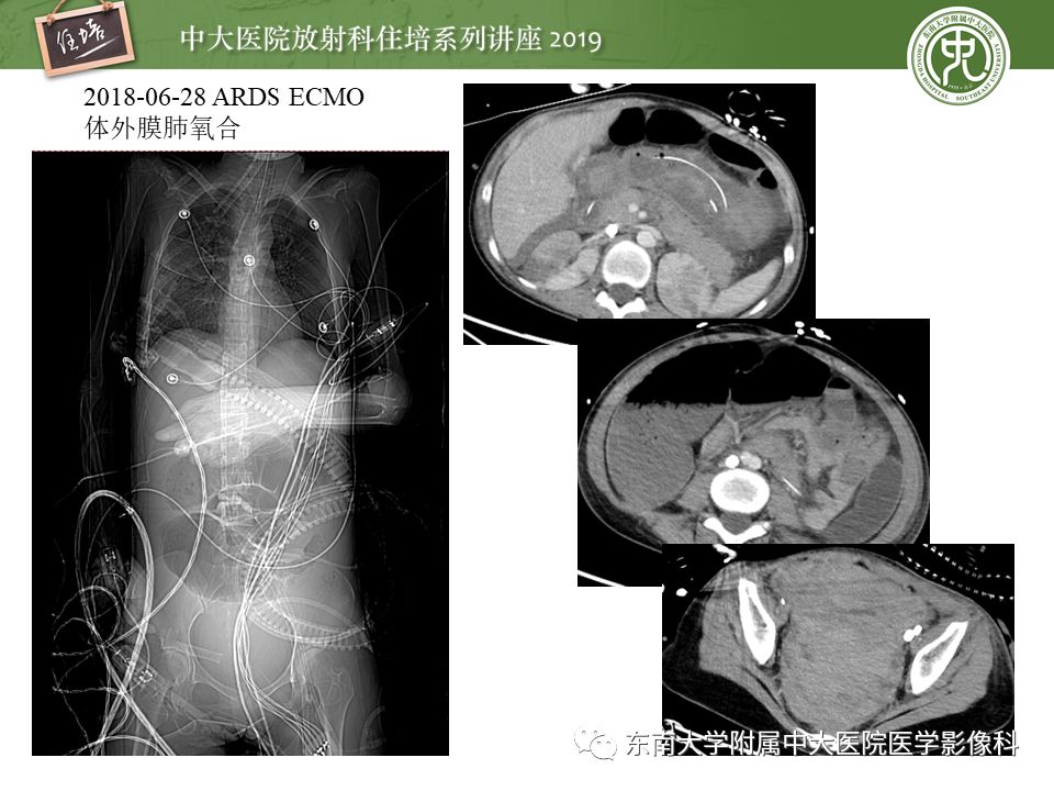 【PPT】肠道急腹症的影像诊断