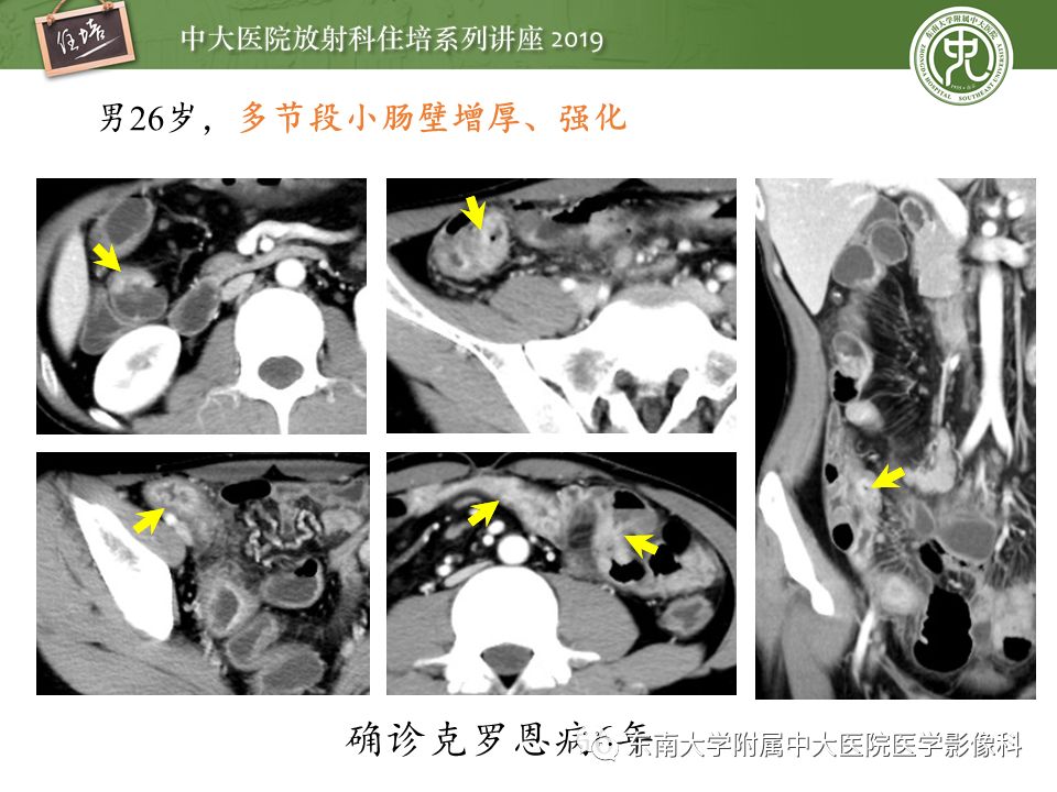 【PPT】肠道急腹症的影像诊断
