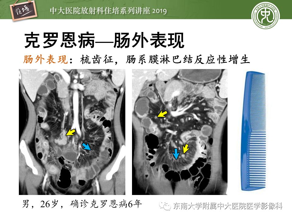 【PPT】肠道急腹症的影像诊断