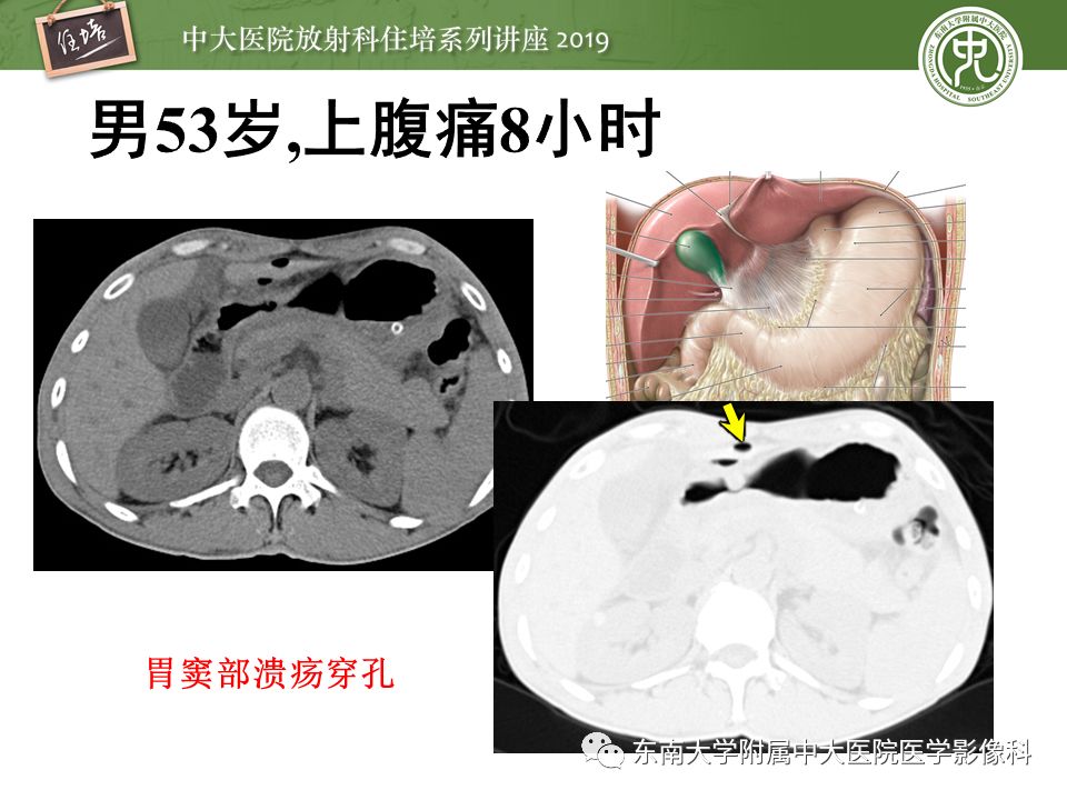 【PPT】肠道急腹症的影像诊断