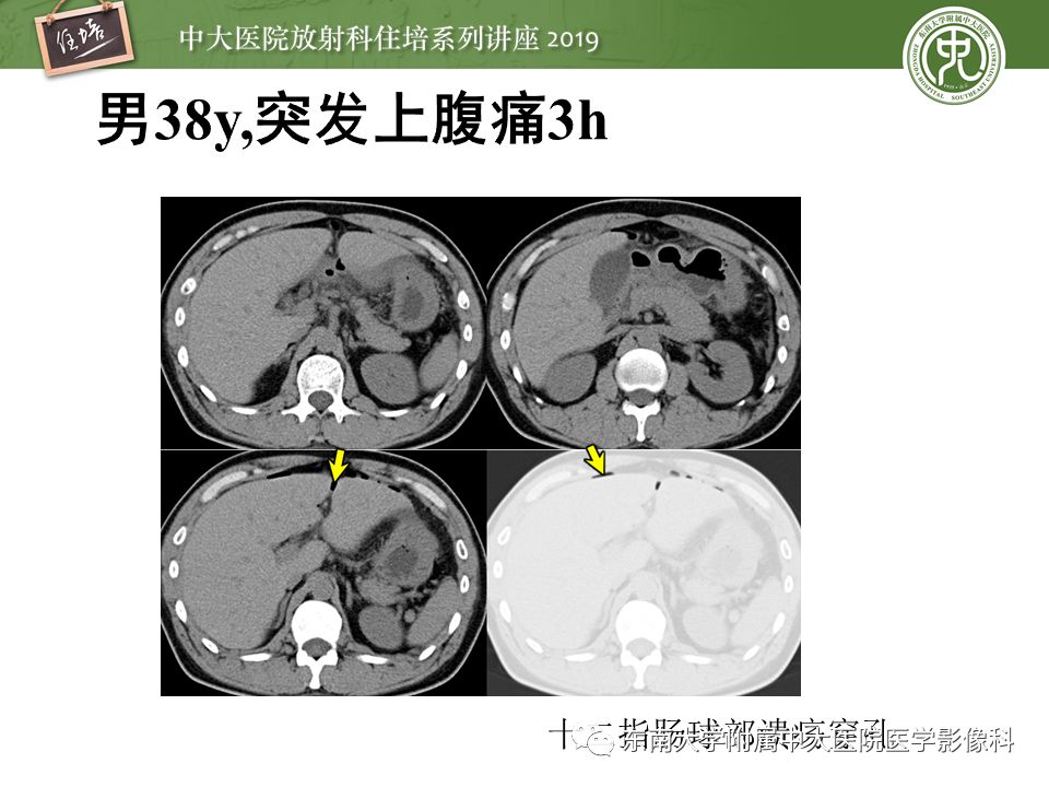 【PPT】肠道急腹症的影像诊断