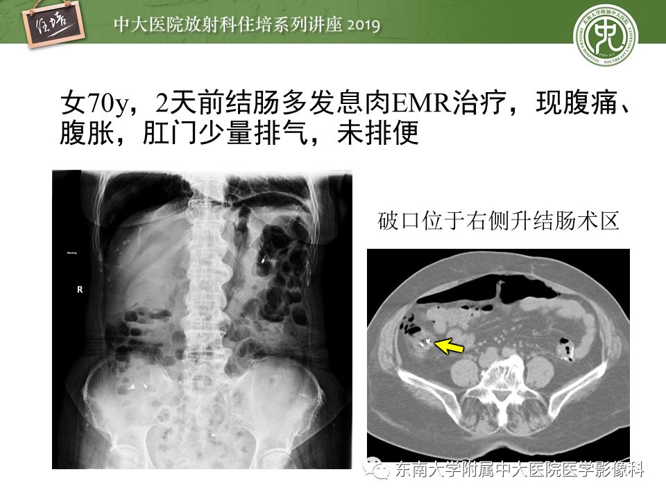 【PPT】肠道急腹症的影像诊断