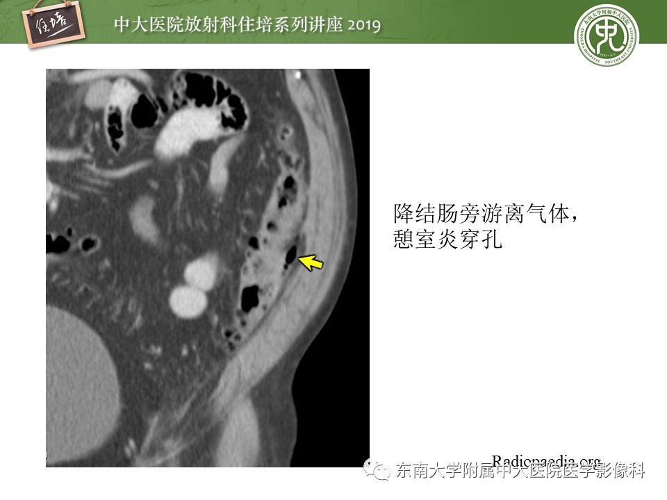 【PPT】肠道急腹症的影像诊断