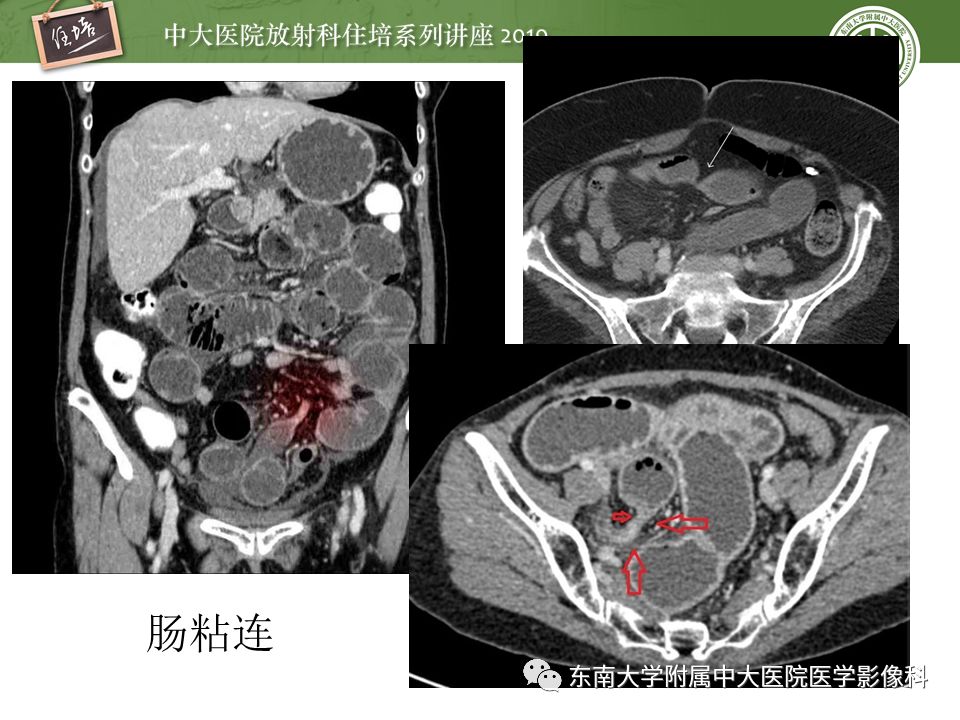 【PPT】肠道急腹症的影像诊断