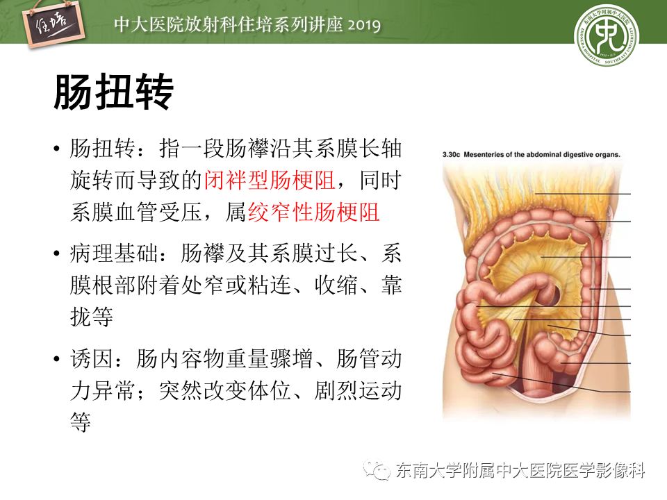 【PPT】肠道急腹症的影像诊断