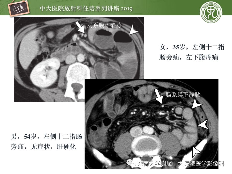 【PPT】肠道急腹症的影像诊断