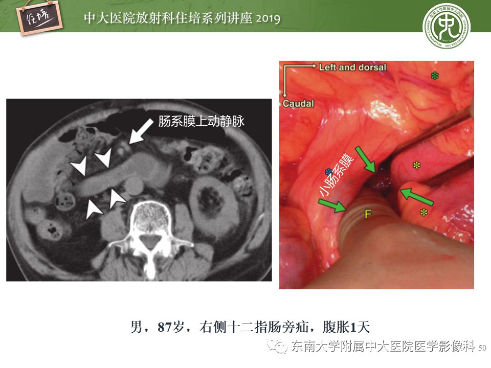 【PPT】肠道急腹症的影像诊断