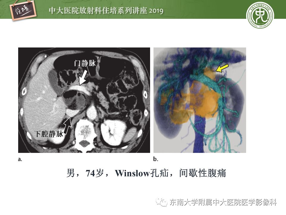 【PPT】肠道急腹症的影像诊断