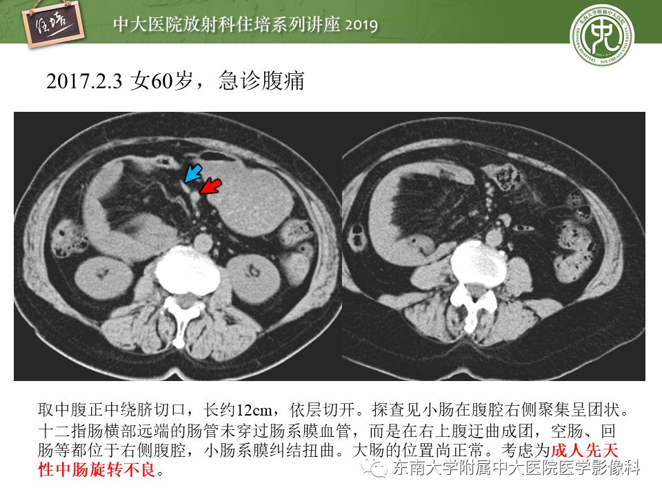 【PPT】肠道急腹症的影像诊断