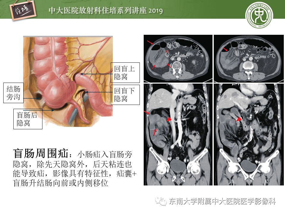 【PPT】肠道急腹症的影像诊断