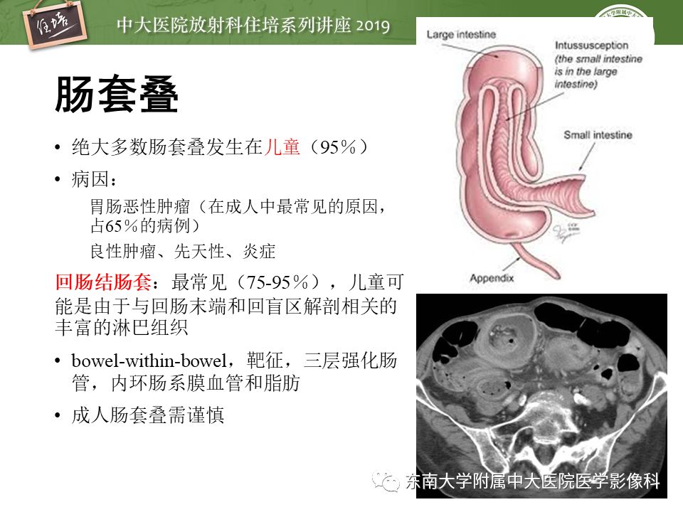【PPT】肠道急腹症的影像诊断