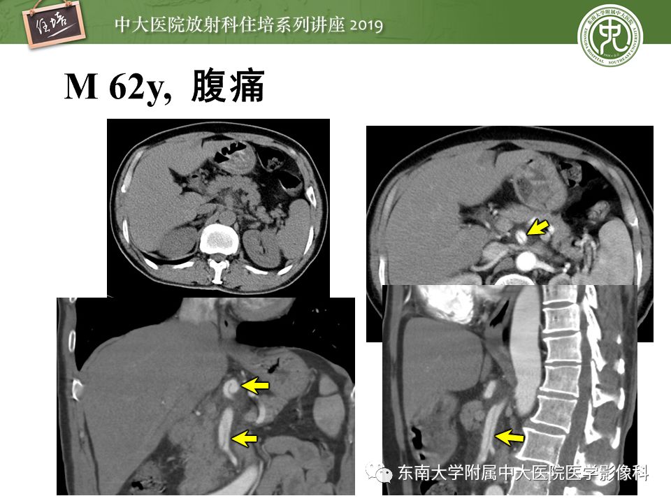 【PPT】肠道急腹症的影像诊断