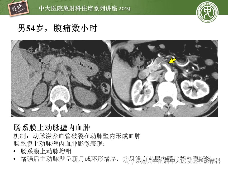【PPT】肠道急腹症的影像诊断