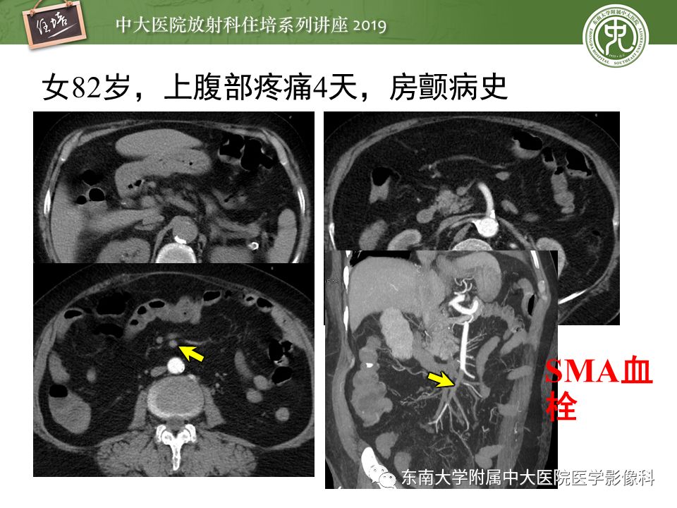 【PPT】肠道急腹症的影像诊断