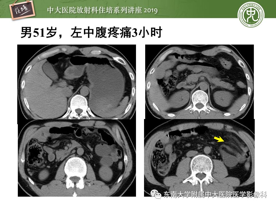 【PPT】肠道急腹症的影像诊断