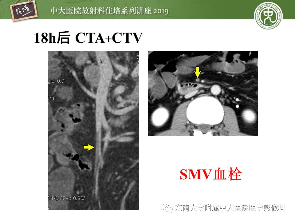 【PPT】肠道急腹症的影像诊断