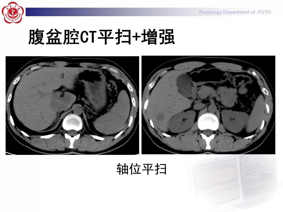 【病例】肝脏上皮样血管内皮瘤1例CT及MR