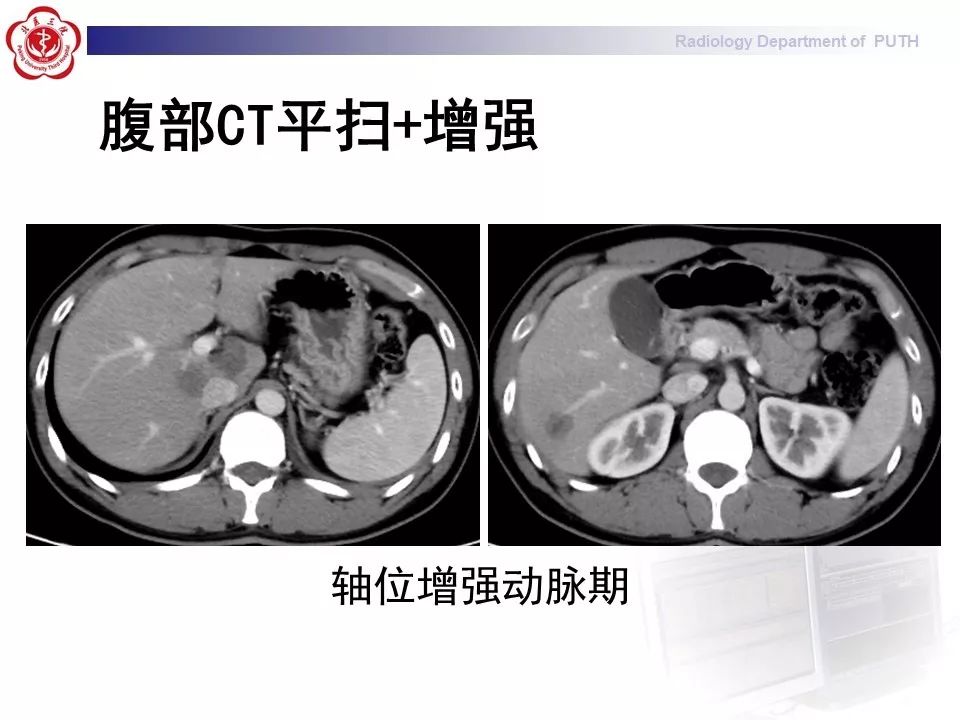 【病例】肝脏上皮样血管内皮瘤1例CT及MR