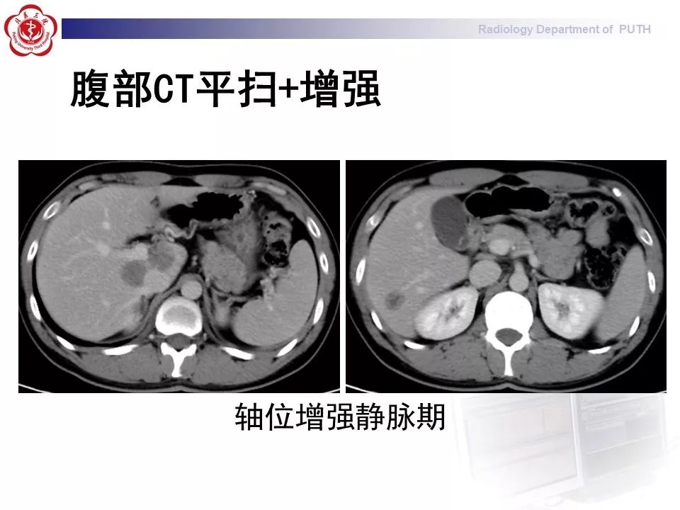 【病例】肝脏上皮样血管内皮瘤1例CT及MR