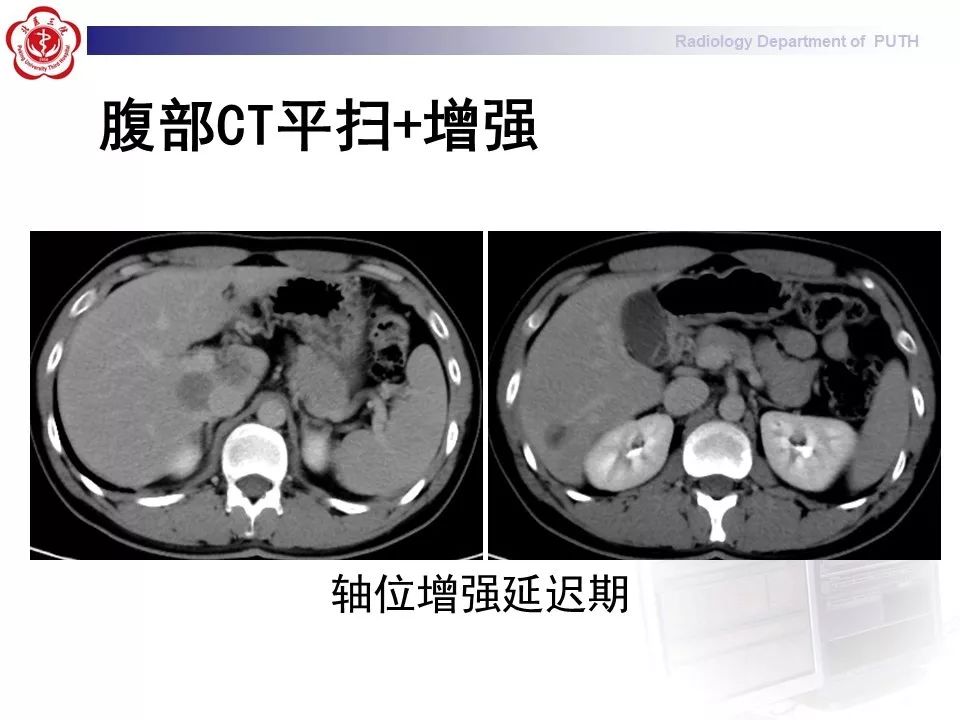 【病例】肝脏上皮样血管内皮瘤1例CT及MR