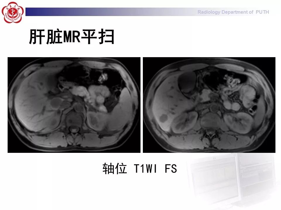 【病例】肝脏上皮样血管内皮瘤1例CT及MR