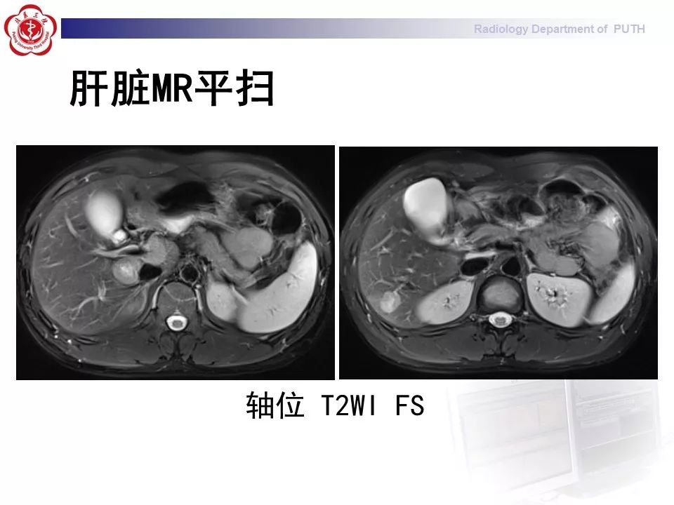 【病例】肝脏上皮样血管内皮瘤1例CT及MR