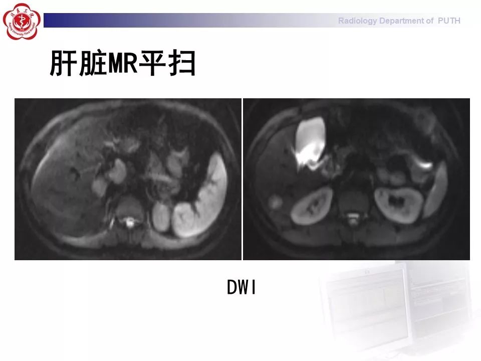 【病例】肝脏上皮样血管内皮瘤1例CT及MR