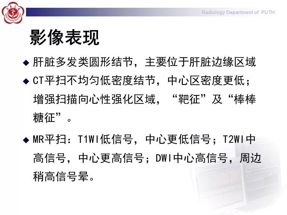 【病例】肝脏上皮样血管内皮瘤1例CT及MR