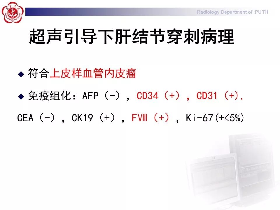 【病例】肝脏上皮样血管内皮瘤1例CT及MR
