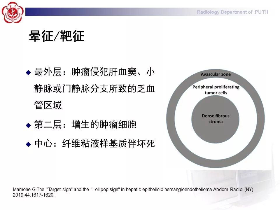 【病例】肝脏上皮样血管内皮瘤1例CT及MR