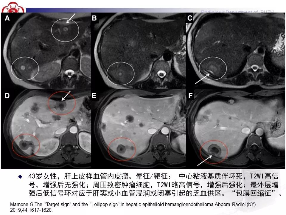 【病例】肝脏上皮样血管内皮瘤1例CT及MR