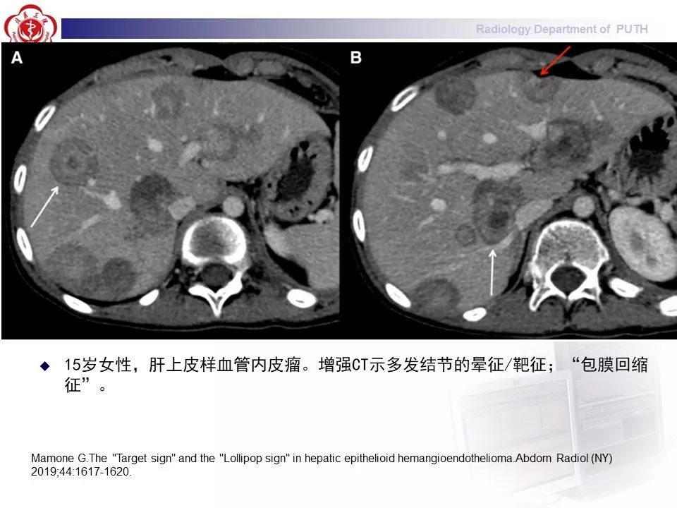 【病例】肝脏上皮样血管内皮瘤1例CT及MR