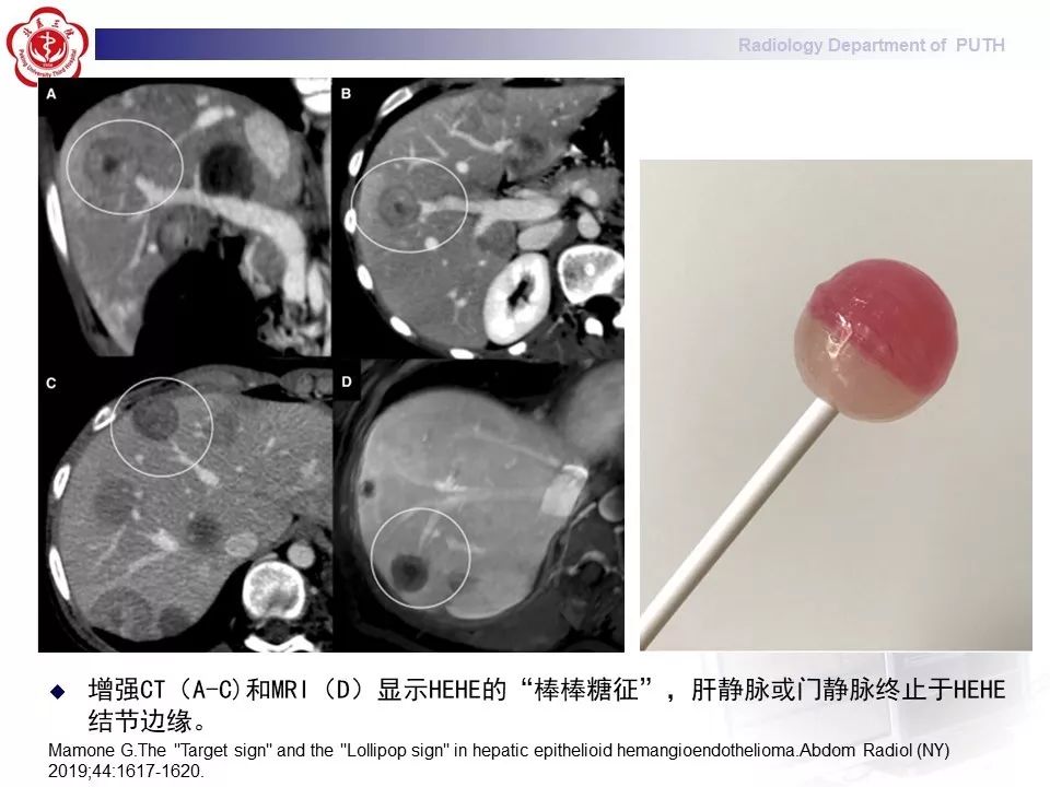 【病例】肝脏上皮样血管内皮瘤1例CT及MR