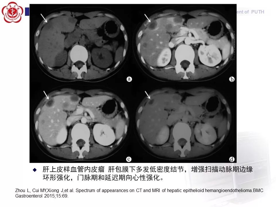 【病例】肝脏上皮样血管内皮瘤1例CT及MR