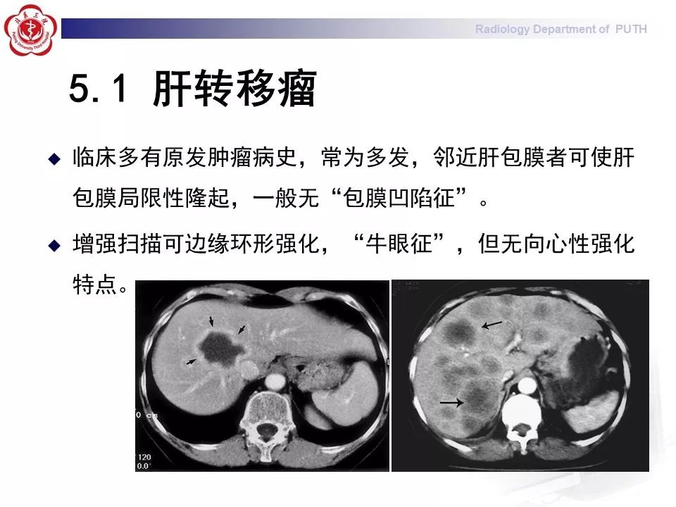 【病例】肝脏上皮样血管内皮瘤1例CT及MR