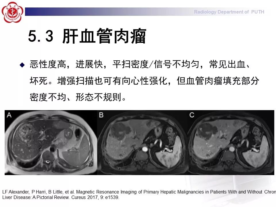 【病例】肝脏上皮样血管内皮瘤1例CT及MR