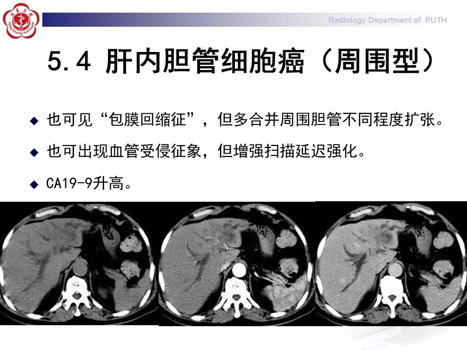 【病例】肝脏上皮样血管内皮瘤1例CT及MR
