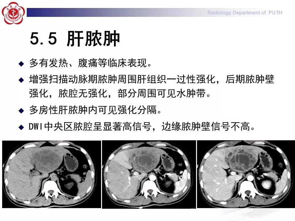 【病例】肝脏上皮样血管内皮瘤1例CT及MR