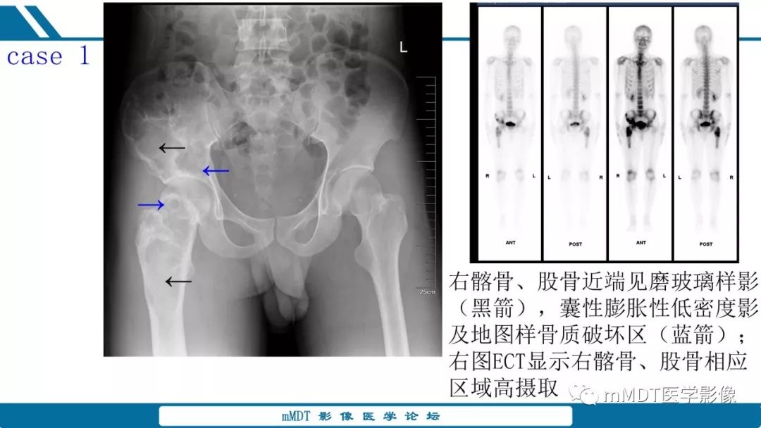【PPT】未定性骨肿瘤影像学表现