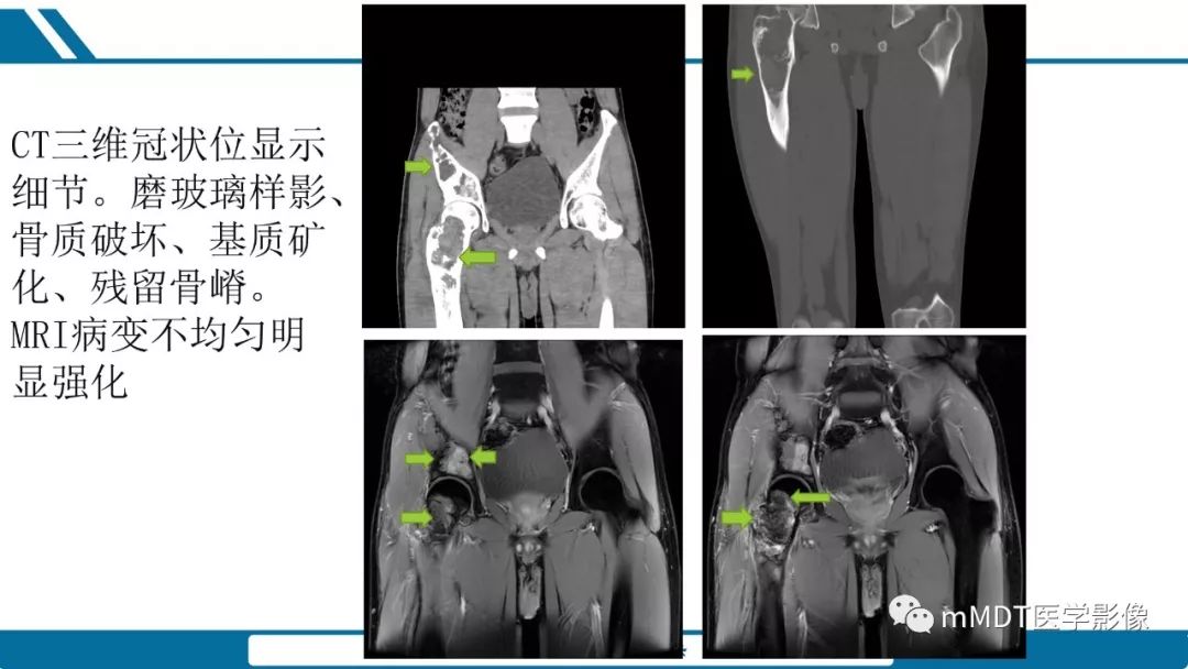 【PPT】未定性骨肿瘤影像学表现