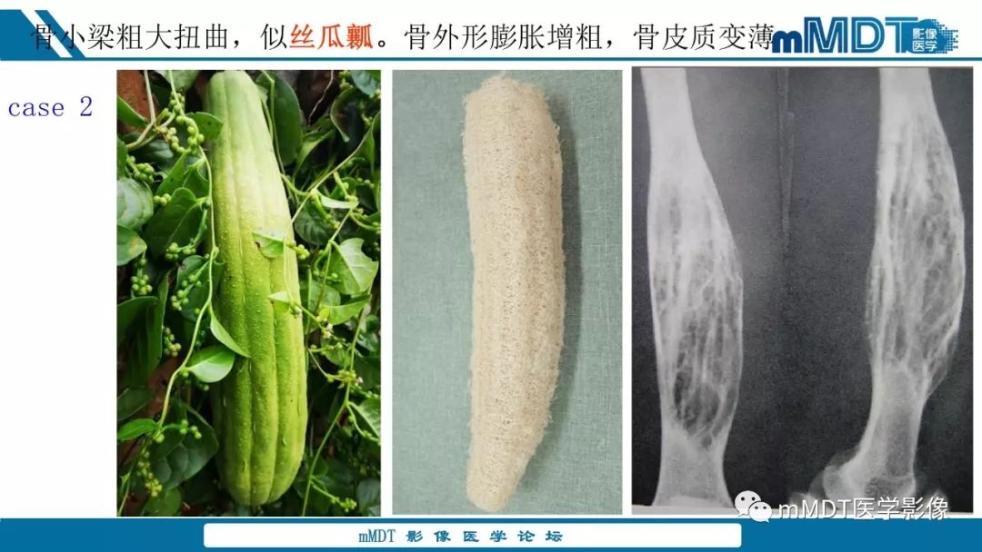 【PPT】未定性骨肿瘤影像学表现