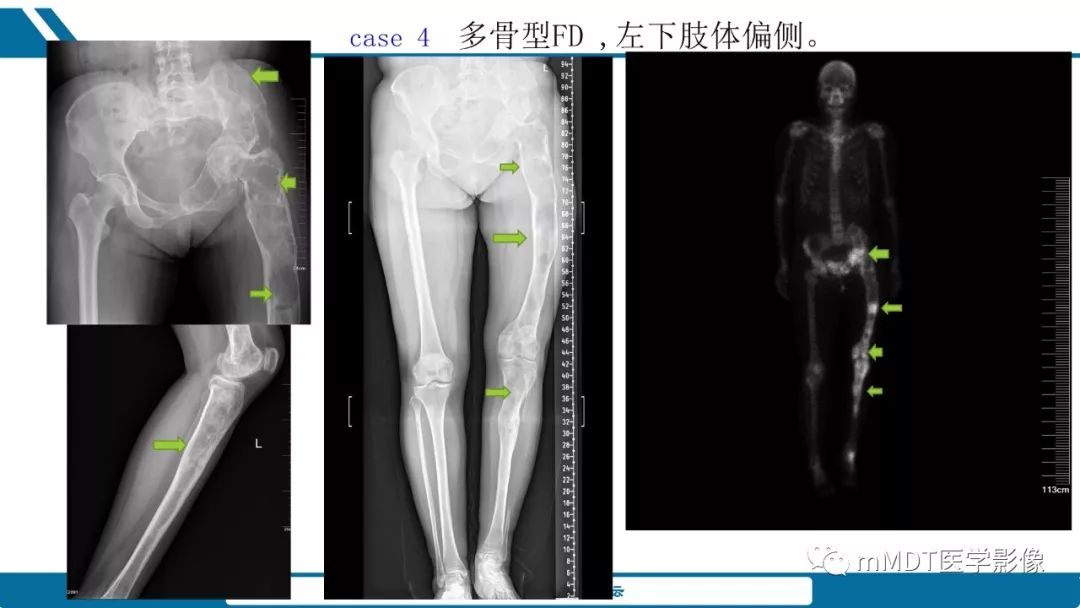 【PPT】未定性骨肿瘤影像学表现