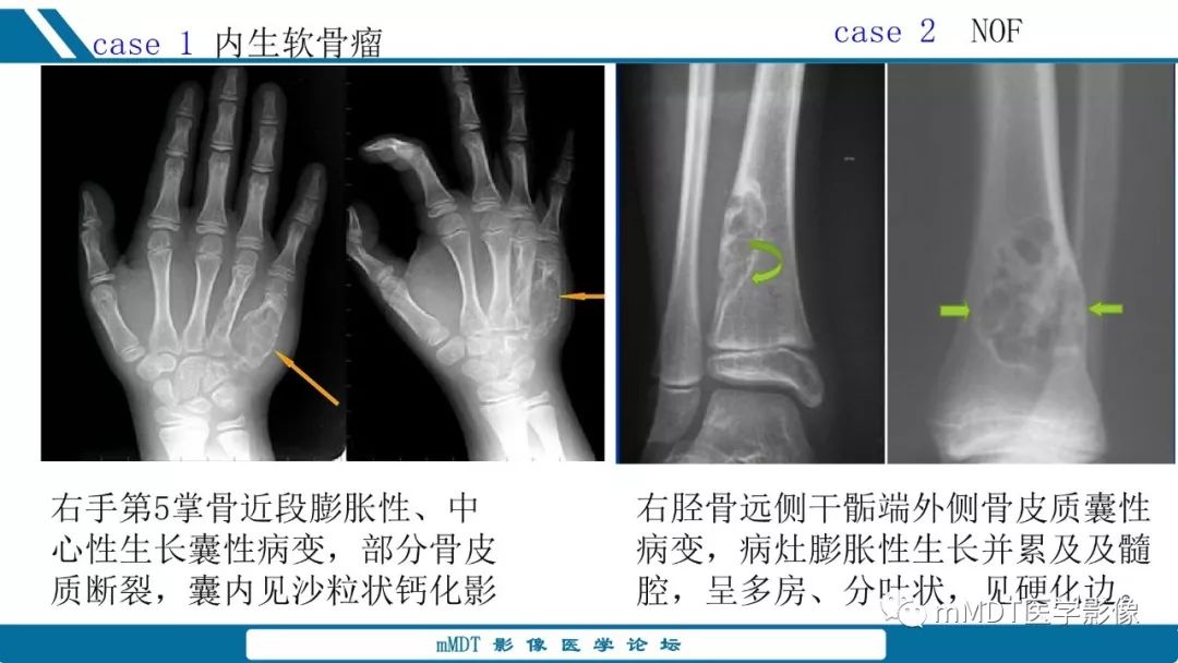 【PPT】未定性骨肿瘤影像学表现