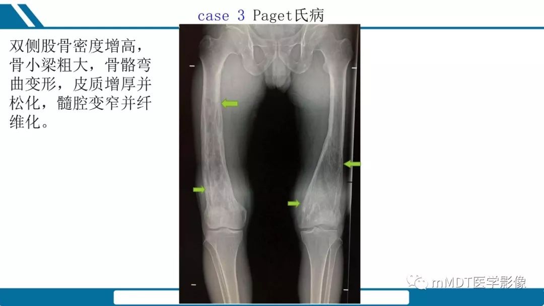 【PPT】未定性骨肿瘤影像学表现